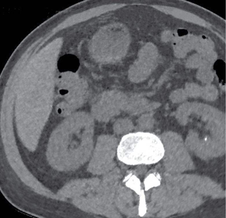 CT images with FBP show a stone at the tip of the left renal calyx